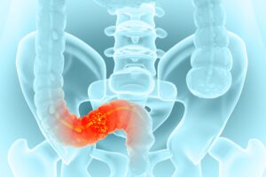 AulaPlus Formación ¡Alarma médica! Una bacteria de la infancia podría estar detrás del aumento de cáncer de colon en jóvenes