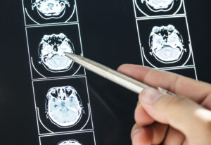 AulaPlus Formación ¡Sorpresa médica! Un fármaco para el alcoholismo podría ser tu salvavidas tras un accidente grave